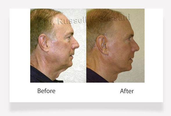 Face lift results on male patient
