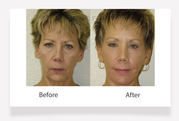 Face lift results on female patient