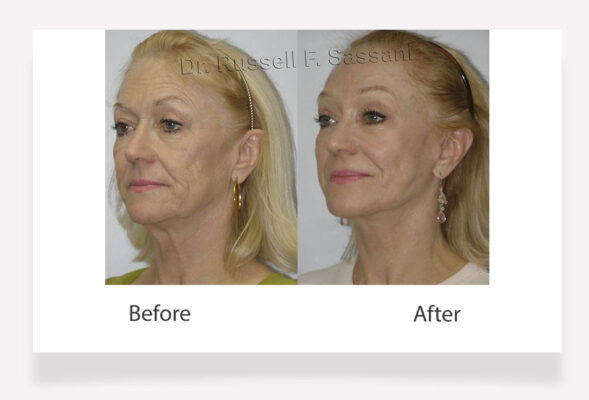 Face lift results on female patient