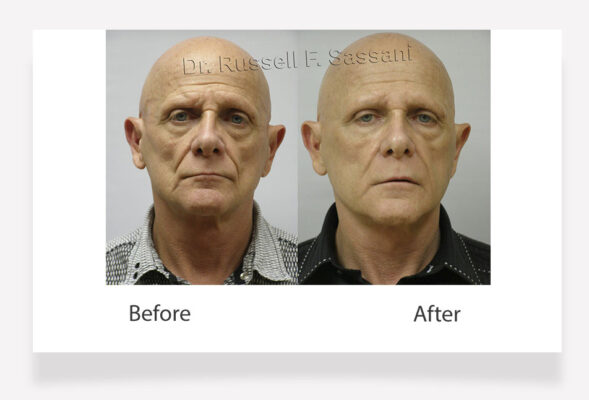 Fat grafting results on male patient