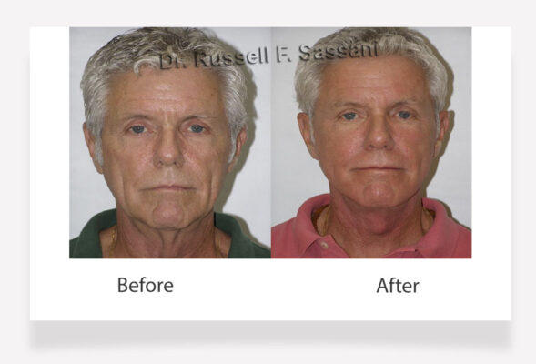 Fat grafting results on male patient