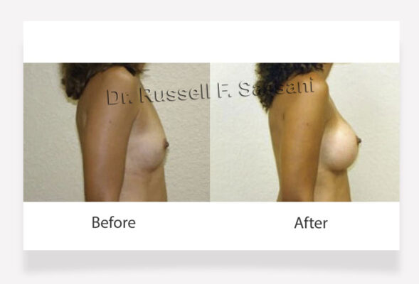 Breast Lift Results on Female Patient