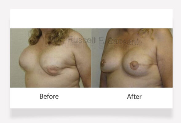 Breast Implant Revision results on female patient