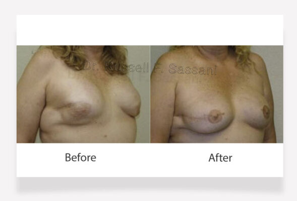 Breast Implant Revision results on female patient