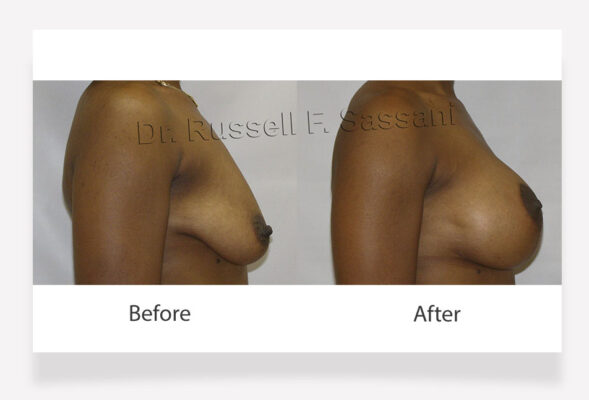 Breast Lift Augmentation Results on Female Patient