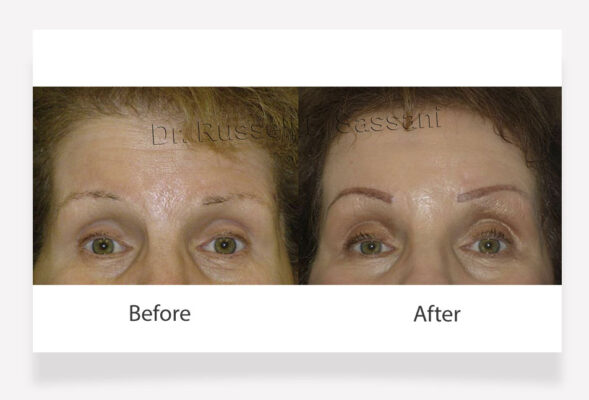 Brow lift results on older female patient