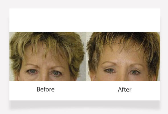 Brow lift results on older female patient