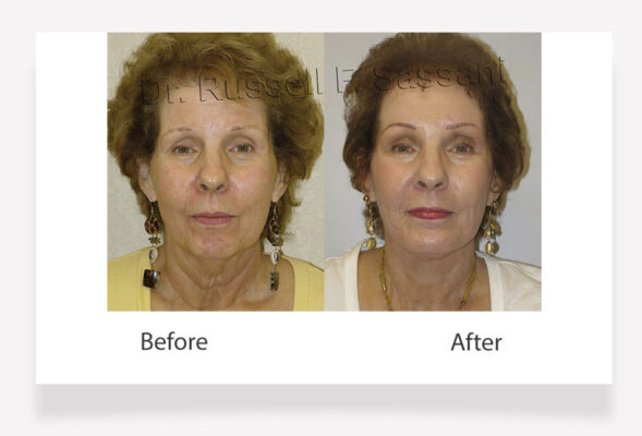 Female chin surgery results