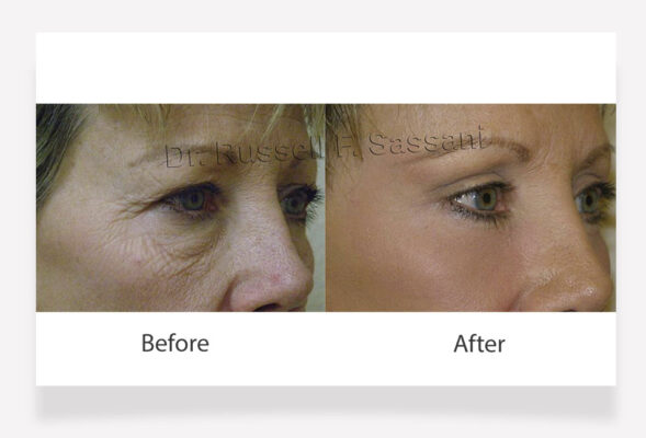 Eyelid surgery results on female patient