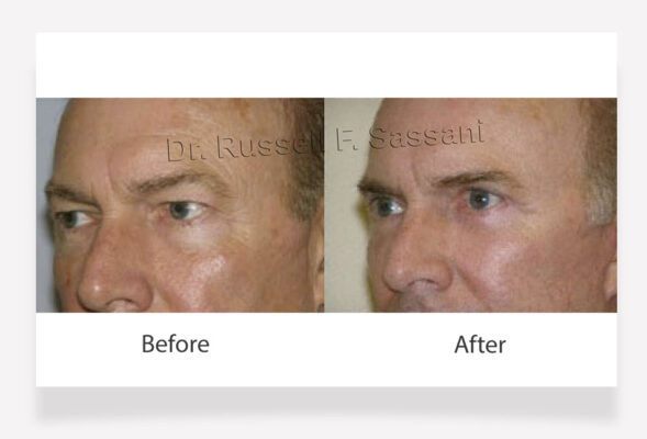 Eyelid surgery results on male patient