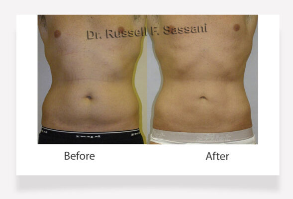 Liposuction results on male patient