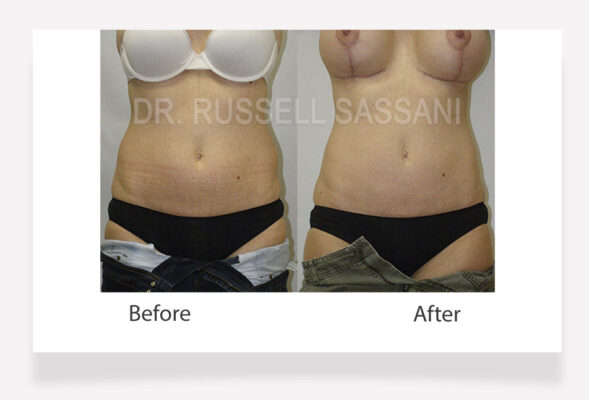 Liposuction results on female patient