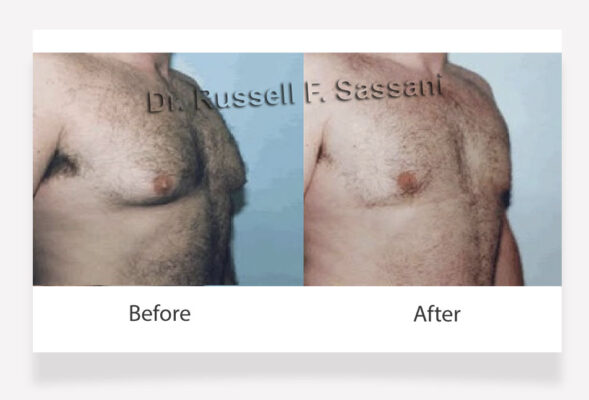 Male breast reduction results