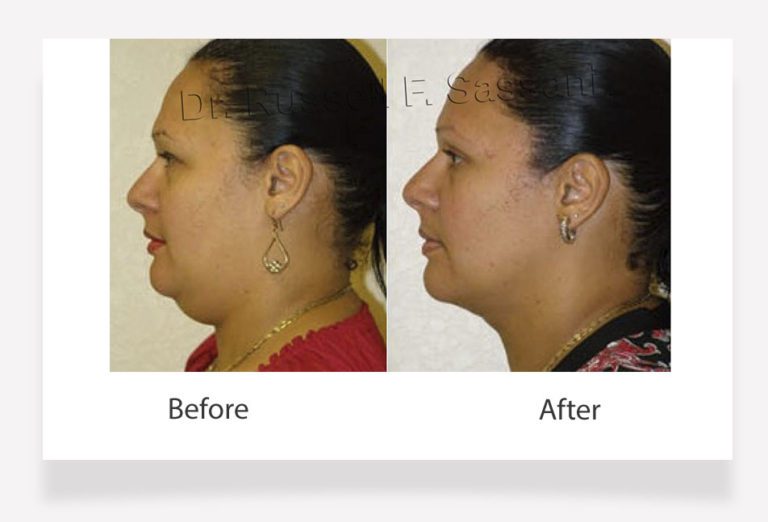 Double Chin Surgery Fort Lauderdale Cosmetic Surgery