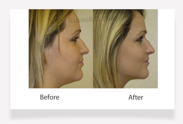 Neck Liposuction results on female patient