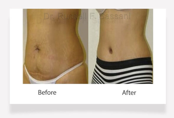 Tummy tuck results on a female patient