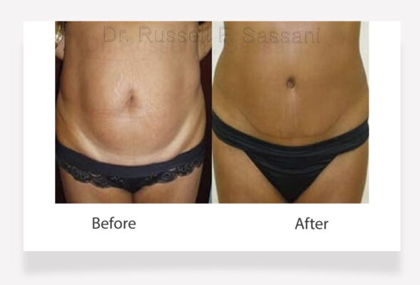 Tummy tuck results on a female patient