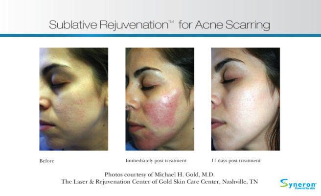 Before and after results of sublative skin rejuvenation