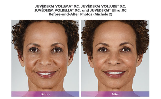 Juvederm results on a middle aged female patient