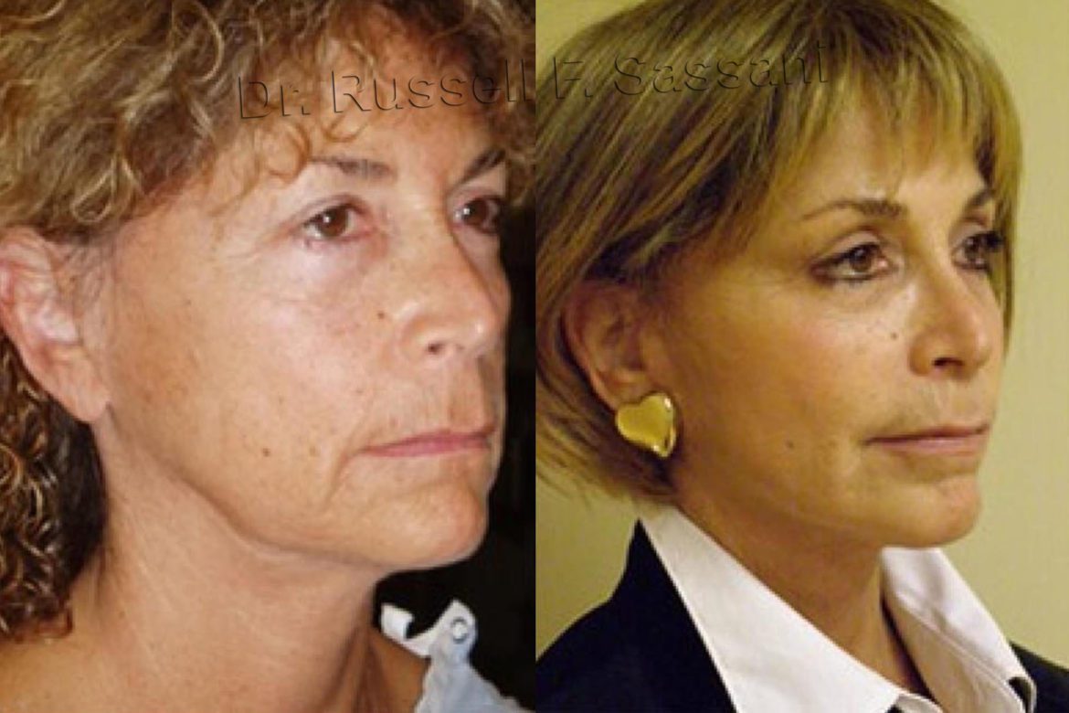 Before and after results of a face lift on an older woman