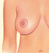 A woman who just underwent a breast lift procedure