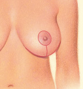 A woman with red markings on breasts
