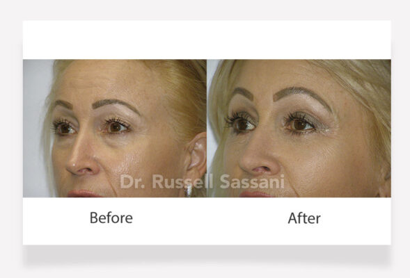 Before and after results of eyelid surgery on a female patient