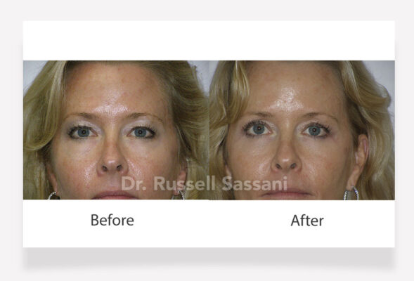 Before and after results of eyelid surgery on a female patient