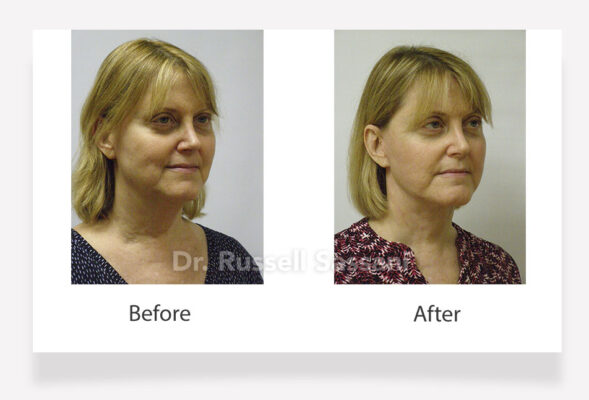 Before and after results of a face lift done on an older female patient