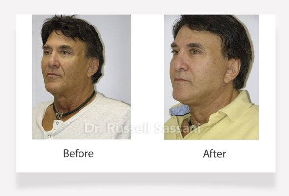 Before and after results of a face lift done on an older male patient