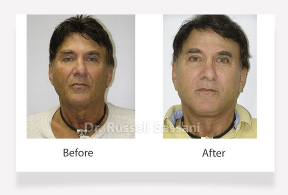 Before and after results of a face lift done on an older male patient
