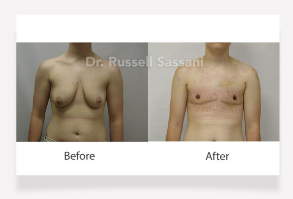 Before and after photos of top surgery