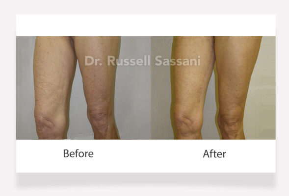 Before and after photos of a thigh lift procedure