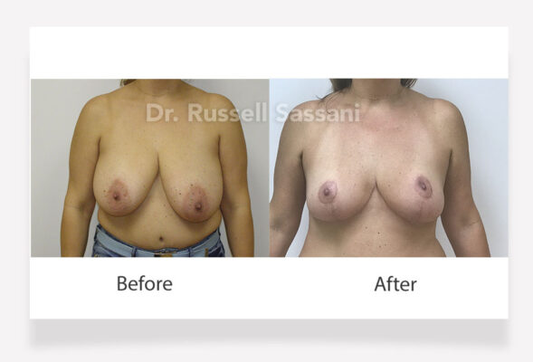 Breast reduction results