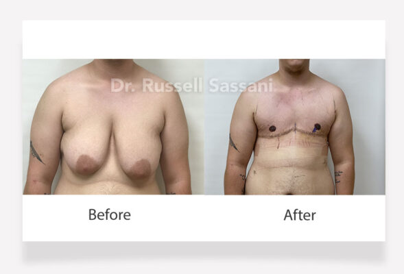 Top surgery results