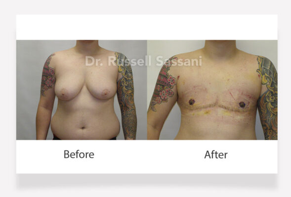 Top surgery results