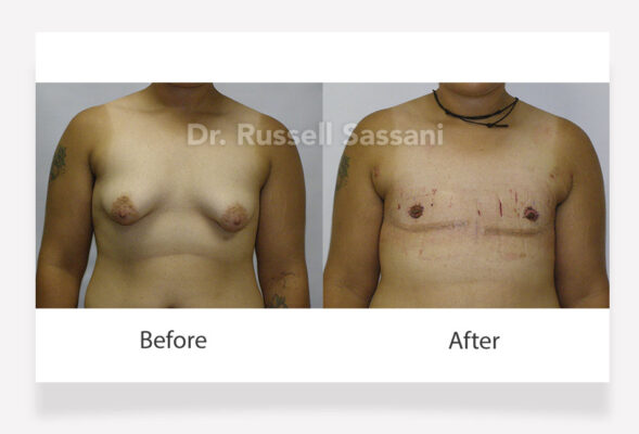 Before and after results of top surgery