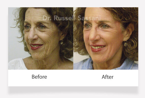 Before and after results of a C02 laser treatment on an older female patient