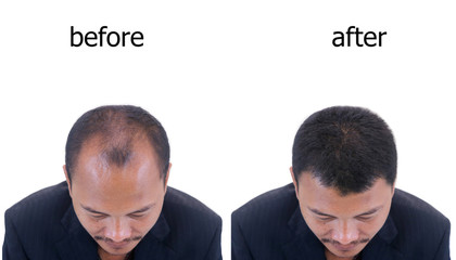 Before and after results of hair transplant