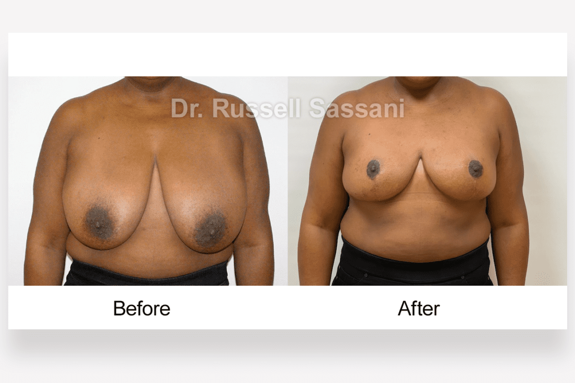 Breast reduction results